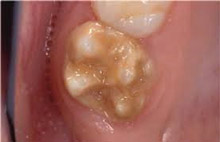 Παιδοδοντίατρος Βίκυ Ορ. Τασιούλα Οδοντίατρος Α.Π.Θ., ειδικευθείσα στην Παιδοδοντιατρική M Dent Sci Leeds Dental Institute, UK | Οδοντίατρος για παιδιά, εφήβους και ειδικούς ασθενείς | Πάροδος Γ. Ολυμπίου 1, 60132 Κατερίνη | Παιδοδοντίατρος στην Κατερίνη, Οδοντίατρος για παιδιά στην Κατερίνη, paidodontiatros katerini