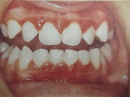 Παιδοδοντίατρος Βίκυ Ορ. Τασιούλα Οδοντίατρος Α.Π.Θ., ειδικευθείσα στην Παιδοδοντιατρική M Dent Sci Leeds Dental Institute, UK | Οδοντίατρος για παιδιά, εφήβους και ειδικούς ασθενείς | Πάροδος Γ. Ολυμπίου 1, 60132 Κατερίνη | Παιδοδοντίατρος στην Κατερίνη, Οδοντίατρος για παιδιά στην Κατερίνη, paidodontiatros katerini